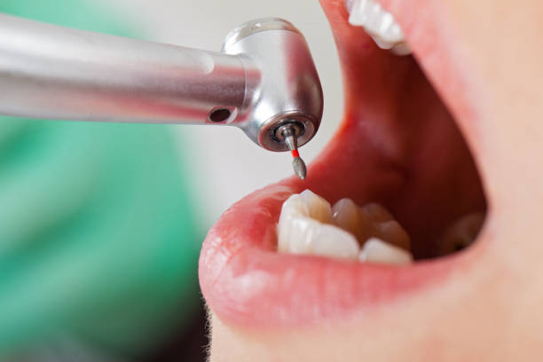 Best Emergency Wisdom Teeth Removal in Fairview, TN